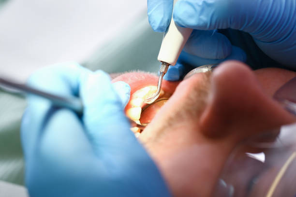Best Emergency Dental Care for Abscessed Tooth in Urbana, IA